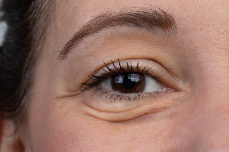 Popular Treatment Options For UnderEye Bags