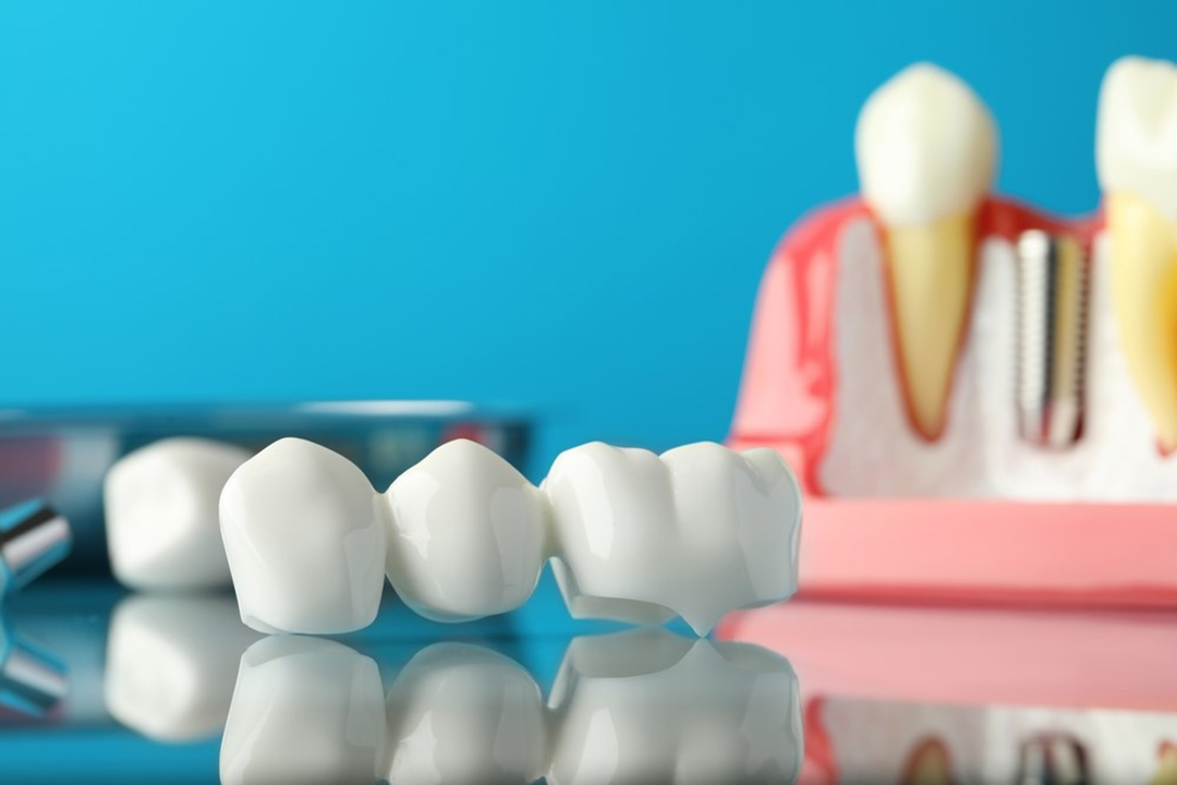Dental Bridge or Dental Implant