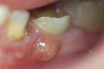Abscess (Acute a)