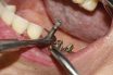 Abutment clamp