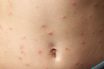 Allergy