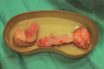 Allogeneic bone graft