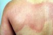Anaphylaxis