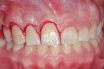 Anatomic crown exposure
