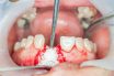 Bone graft