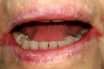 Angular cheilitis
