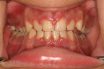 Gingival a