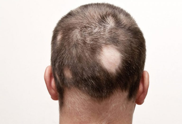 Alopecia Definition Of Alopecia