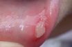 Aphthous ulcer