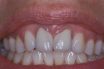 Cosmetic periodontal surgery