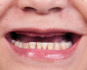 Edentulous - Definition of Edentulous