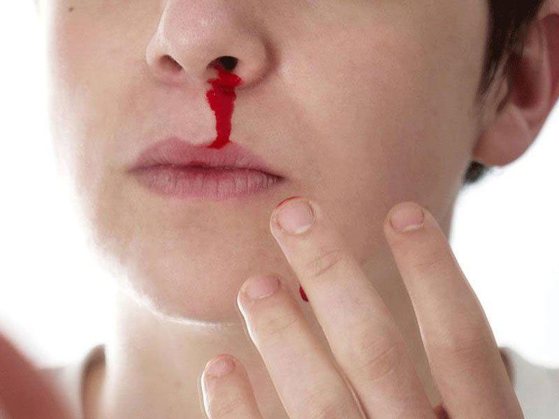 Epistaxis - Definition of Epistaxis