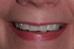 Esthetic reshaping