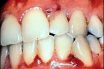 Gingival diseases