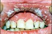 Gingival diseases of fungal origin