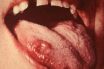 Gingival diseases of specific bacterial origin