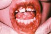 Gingival diseases of viral origin