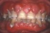 Gingival enlargement