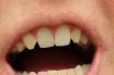Hypodontia
