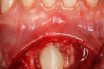 Impaction of tooth