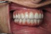 Implant denture