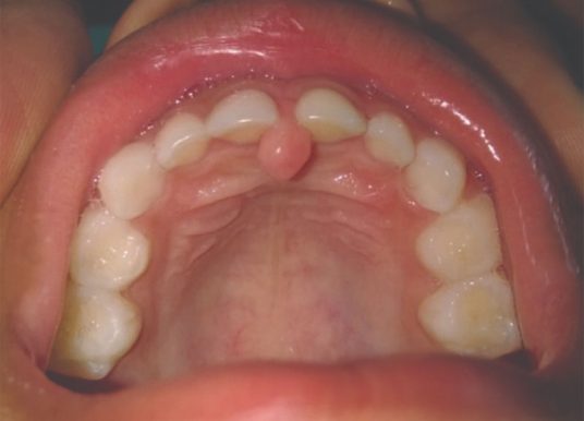 Incisive papilla - Definition of Incisive papilla