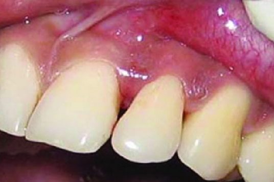Interdental papilla - Definition of Interdental papilla