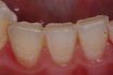 Occlusal wear