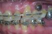 Orthodontic implant