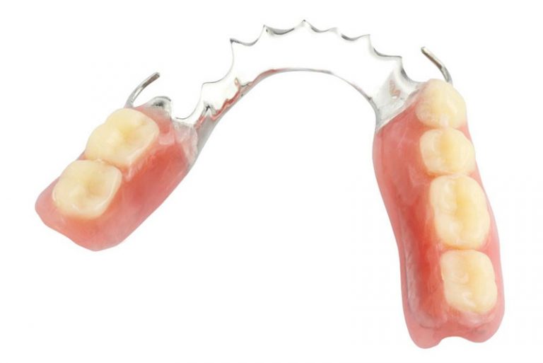 Partial denture Definition of Partial denture