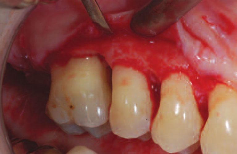 Periodontal suprabony pocket Definition of Periodontal suprabony pocket
