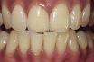 Thick periodontal biotype