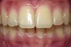 Thin periodontal biotype