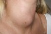 Goiter