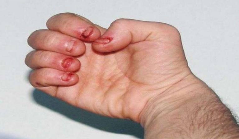 Leschnyhan syndrome Definition of Leschnyhan syndrome