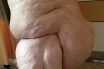 Lipedema (lipoedema)