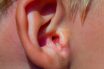 Swimmer’s ear