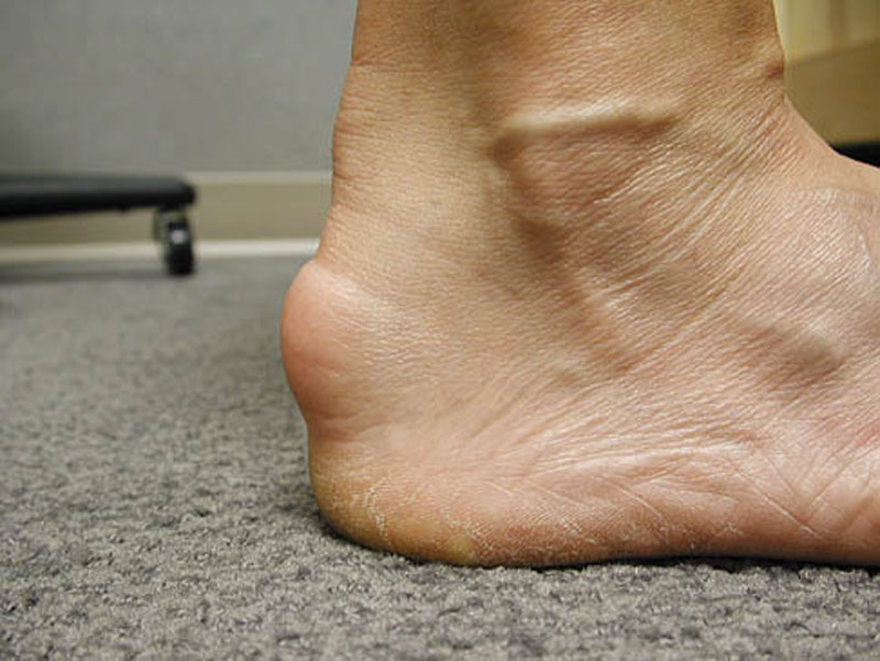Achilles tendonitis Definition of Achilles tendonitis