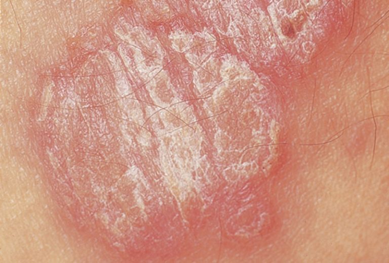 Psoriasis vulgaris Definition of Psoriasis vulgaris