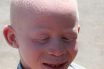 Albinism