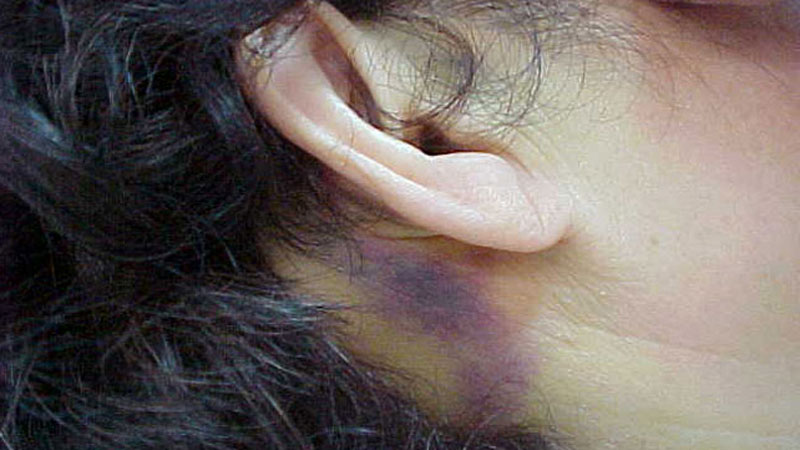 Battle’s sign - Definition of Battle’s sign