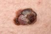 Malignant melanoma