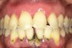 Oral diseases