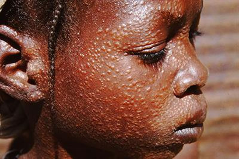 Kalaazar Definition of Kalaazar