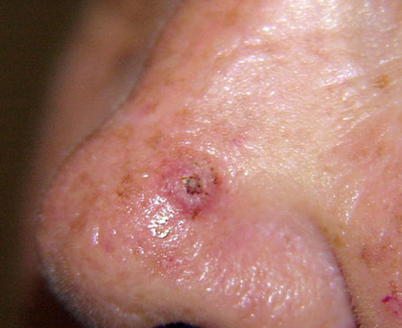Molluscum sebaceum