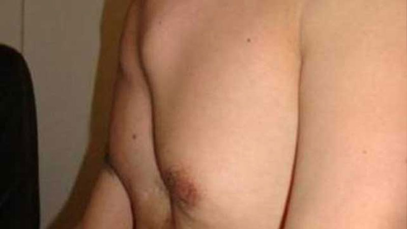 Pectus carinatum