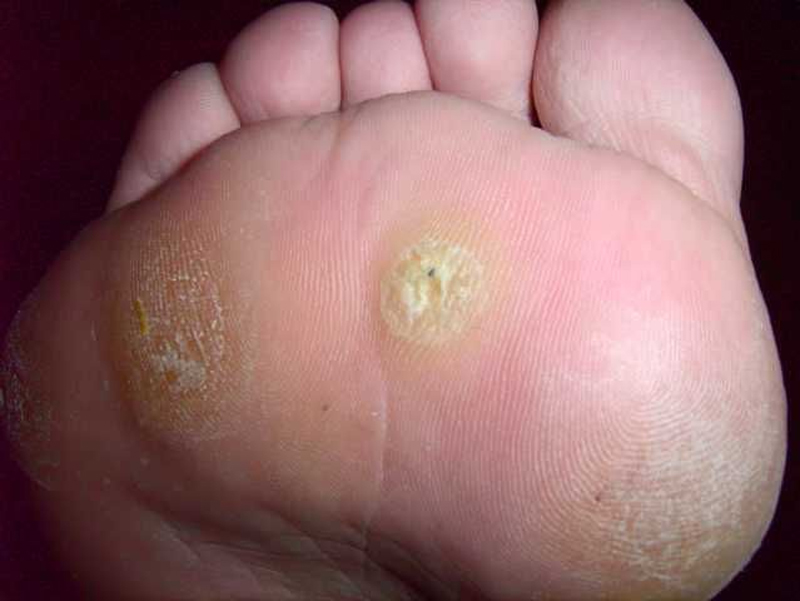Plantar wart