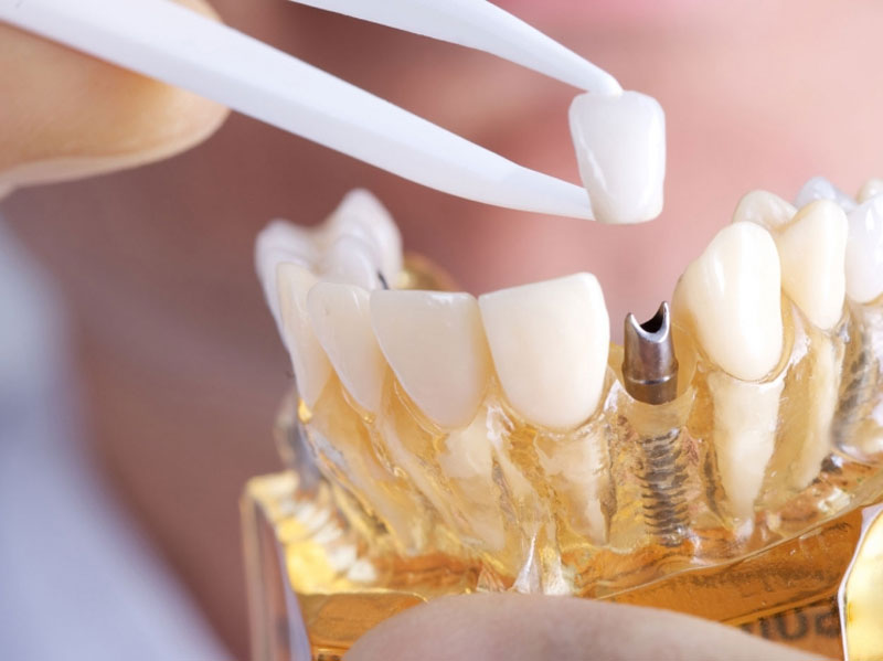 Prosthetic dentistry Definition of Prosthetic dentistry