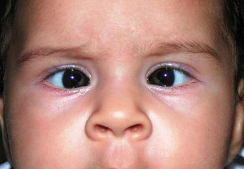 Ребенок косит глазки. Монолатеральное сходящееся косоглазие. Соходашися комоглазие. Косоглазие у детей. Эзотропия сходящееся косоглазие.