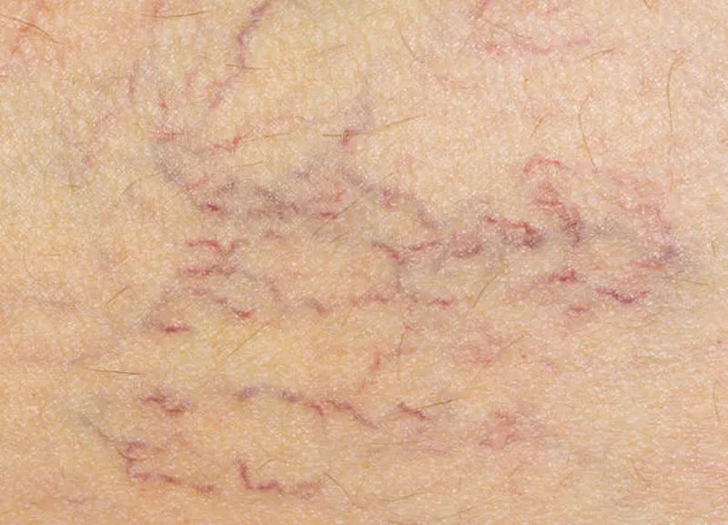 Telangiectasis Definition of Telangiectasis